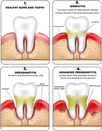 Gum Disease Stages