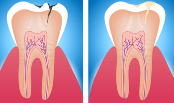 White Tooth Filling Treatment