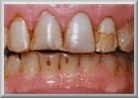 Before Tooth Veneer