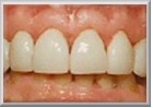 After Tooth Veneer