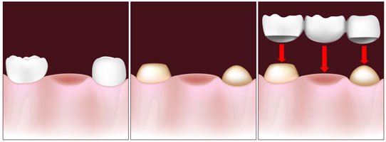 Dental Bridge Procedure