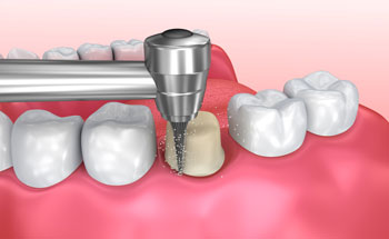 Dental Crowns Procedure