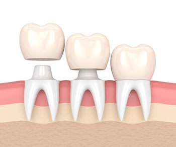 Dental Crowns Tooth Caps Options Procedure Costs