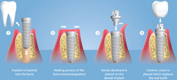 Dental Implant Procedure