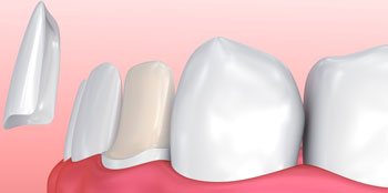 Dental Veneers Procedure