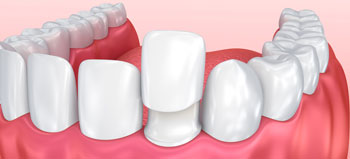 Dental Veneers Treatment