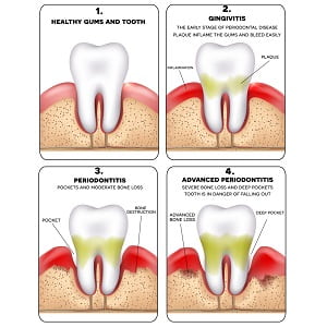 Gingivitis Treatment Options Procedures Costs