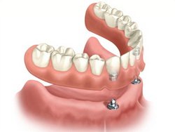 Dental Implant