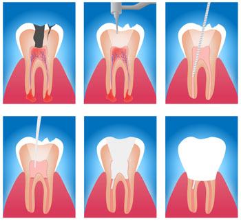 Root Canal Procedure