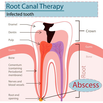 Root Canal Treatment Options Procedures Costs