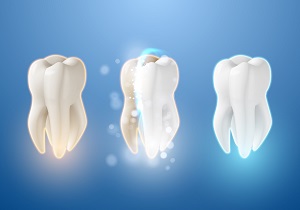 Teeth Whitening: Options, Procedures & Costs