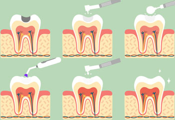 White Tooth Filling Procedure