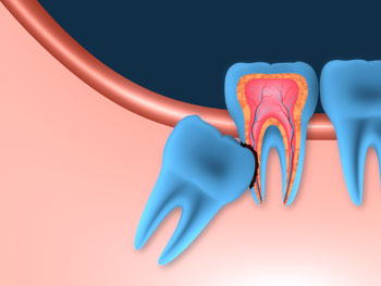 Wisdom Teeth Removal Treatment